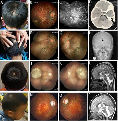 An Early Diagnostic Clue for COL18A1- and LAMA1-Associated Diseases: High Myopia With Alopecia Areata in the Cranial Midline